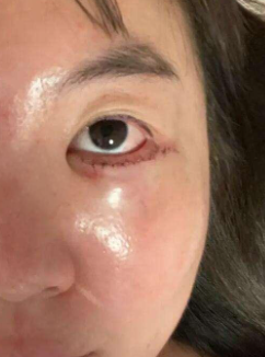 术后常见副作用与应对措施
