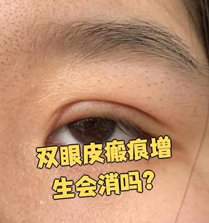 如何有效避免双眼皮术后留疤？