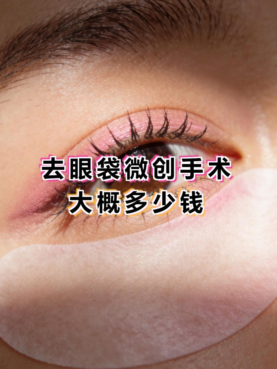 北京不开刀去眼袋价格多少钱?非手术去除眼袋多少钱效果如何插图 北京非手术去眼袋价格范围