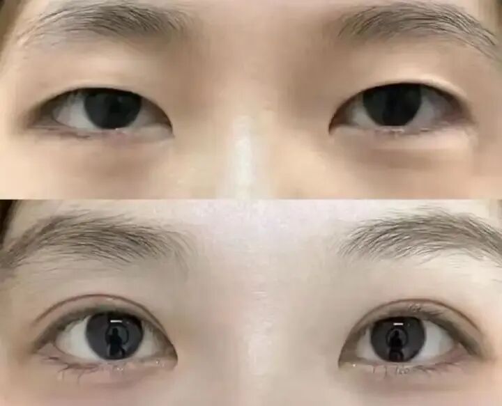 双眼皮术前必看!价格、眼型、优缺点,一次讲透!插图2 图片