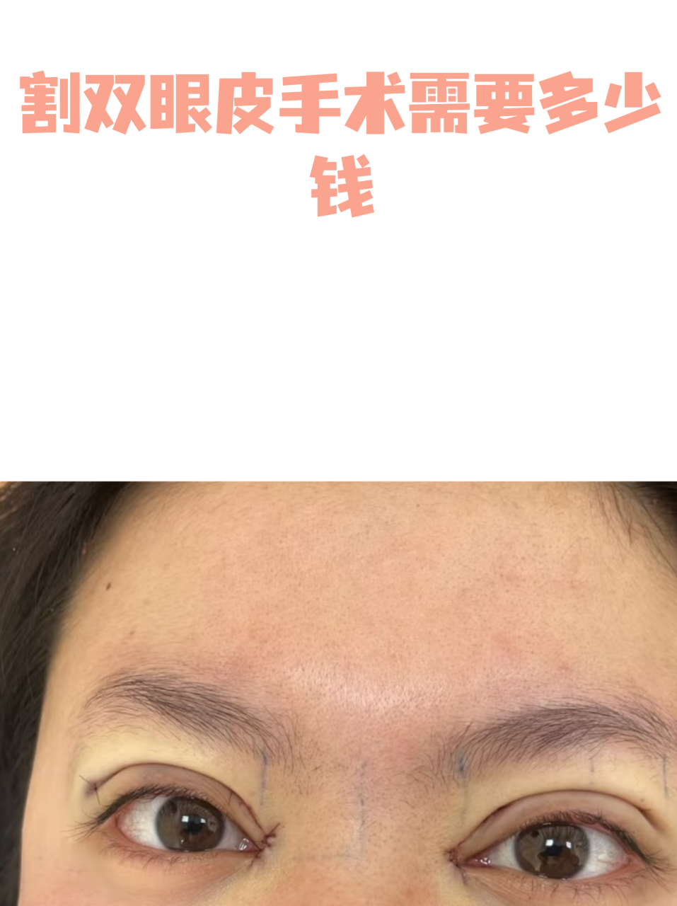 上海全切双眼皮价格多少钱?全切双眼皮手术的费用插图1 手术前后注意事项