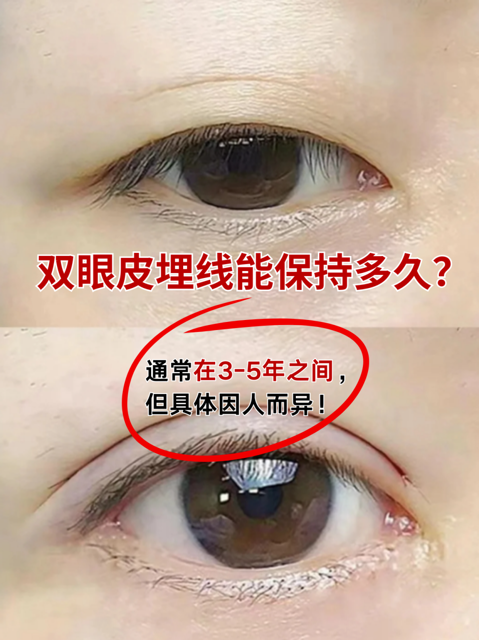 埋线和全切双眼皮哪个好?埋线与全切双眼皮手术效果及恢复期对比插图1 结论:选择适合自己的才是最好的