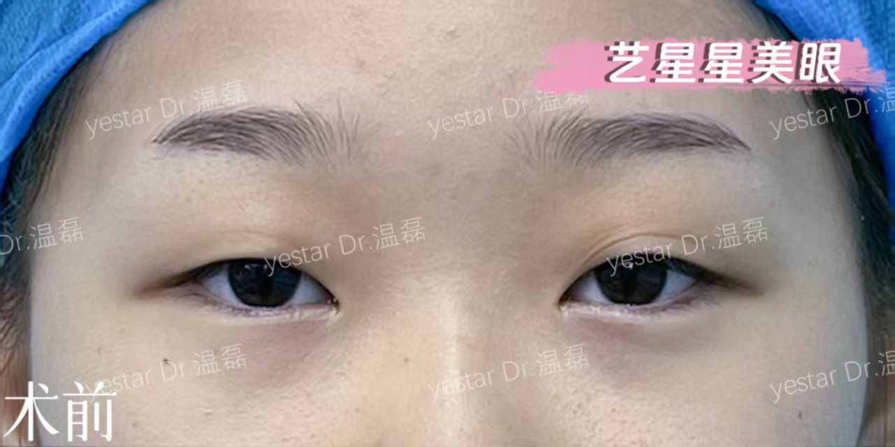术前