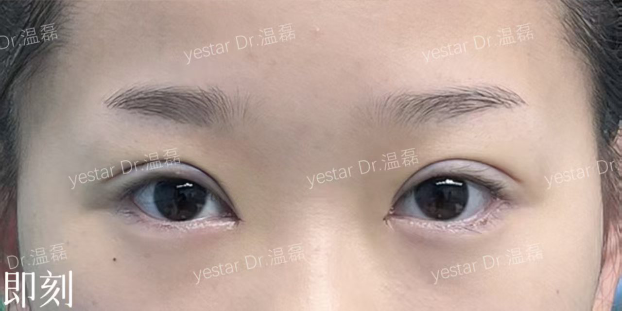 术后