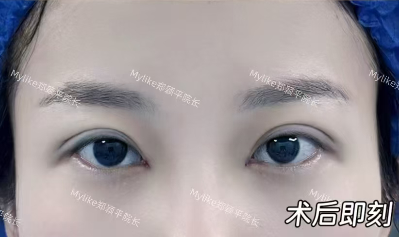 术后