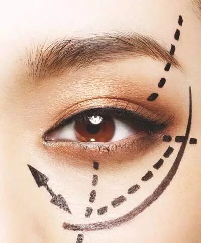 武汉割双眼皮要注意什么吗?武汉割双眼皮危险不危险?插图 图片