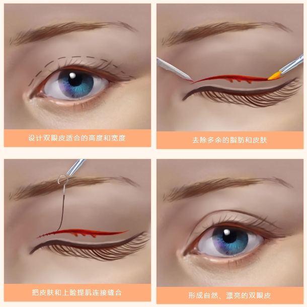 武汉割双眼皮多少钱啊?影响双眼皮手术价格的主要因素有哪些?插图 图片