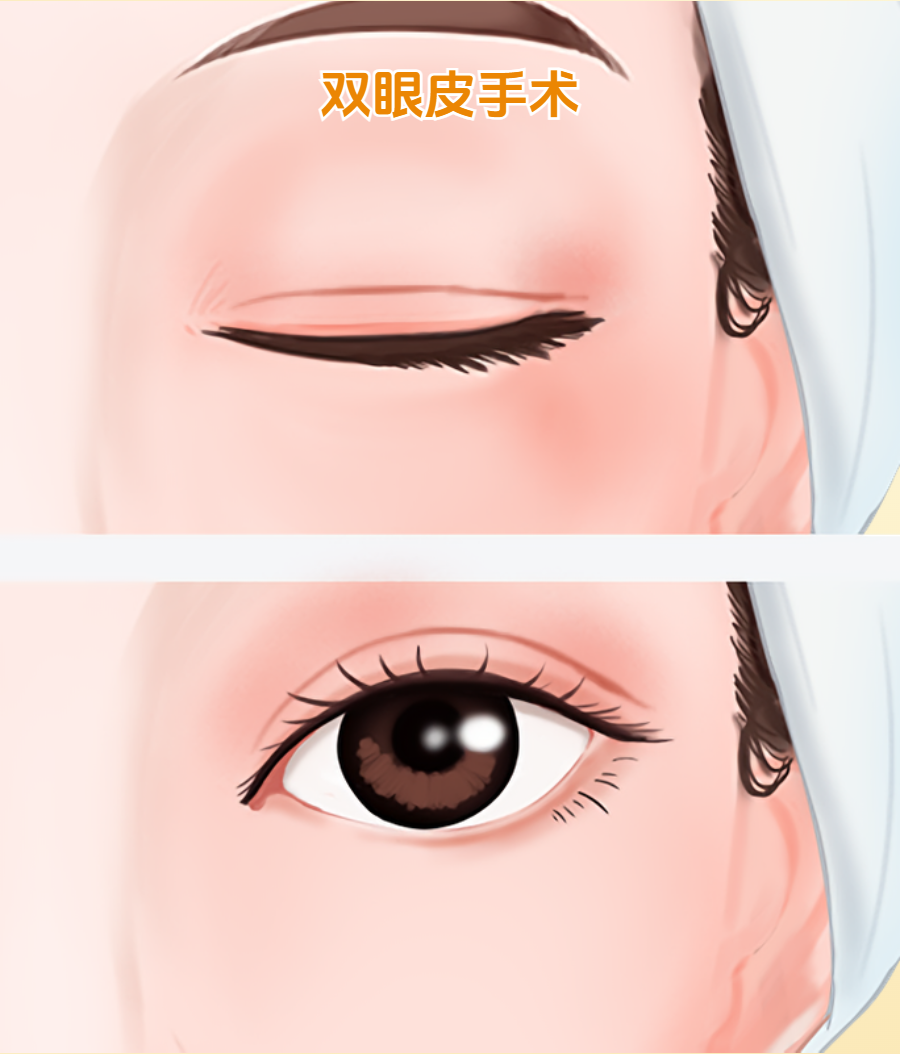 做双眼皮整形的价格?做双眼皮整形能维持多久?插图 图片