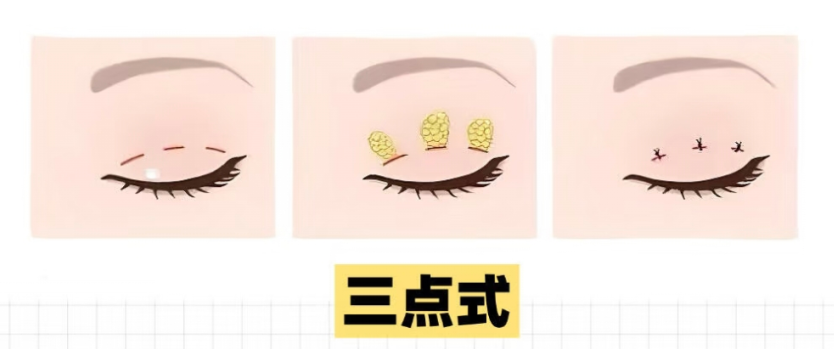 双眼皮做哪种效果好?双眼皮手术后会有瘢痕吗?插图1 图片