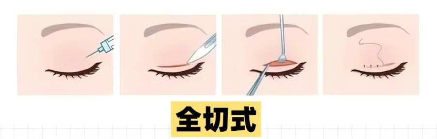 双眼皮做哪种效果好?双眼皮手术后会有瘢痕吗?插图2 图片