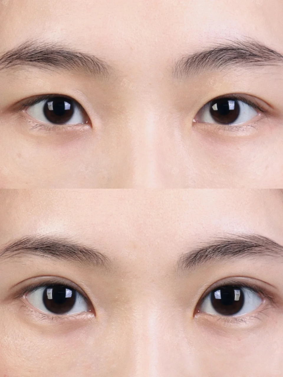 北京做个双眼皮多少钱?做个双眼皮受哪些因素的影响?插图 图片