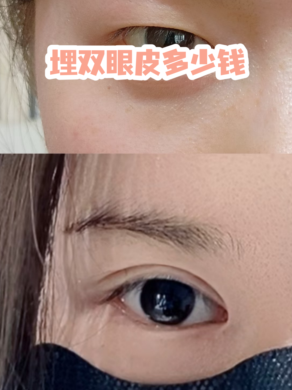 杭州埋线双眼皮价格多少钱?杭州专业美容医院埋线双眼皮手术费用详情插图 推荐几家值得信赖的杭州专业美容医院