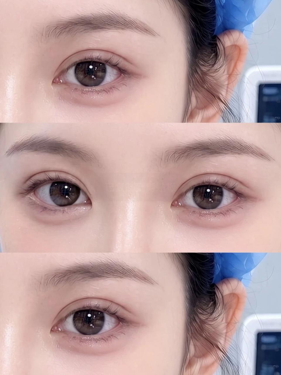 双眼皮有哪些方法?双眼皮能使眼睛变大吗?插图 图片