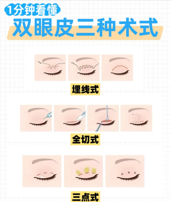双眼皮需要多少费用?双眼皮价位是多少?插图 图片