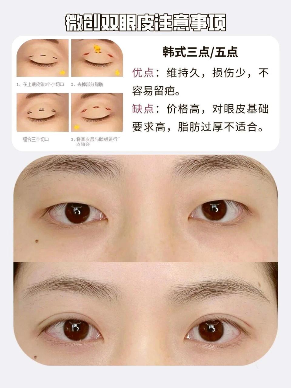 三点双眼皮保持多久?埋线双眼皮手术要求是什么?插图 图片
