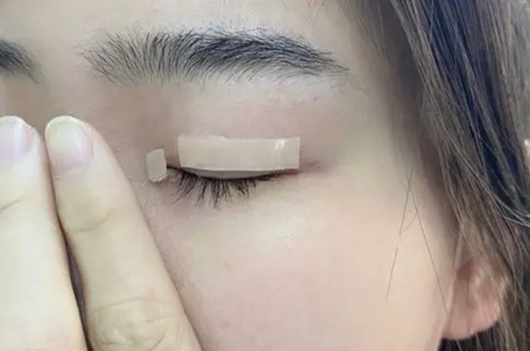 双眼皮手术有疤痕怎么办？