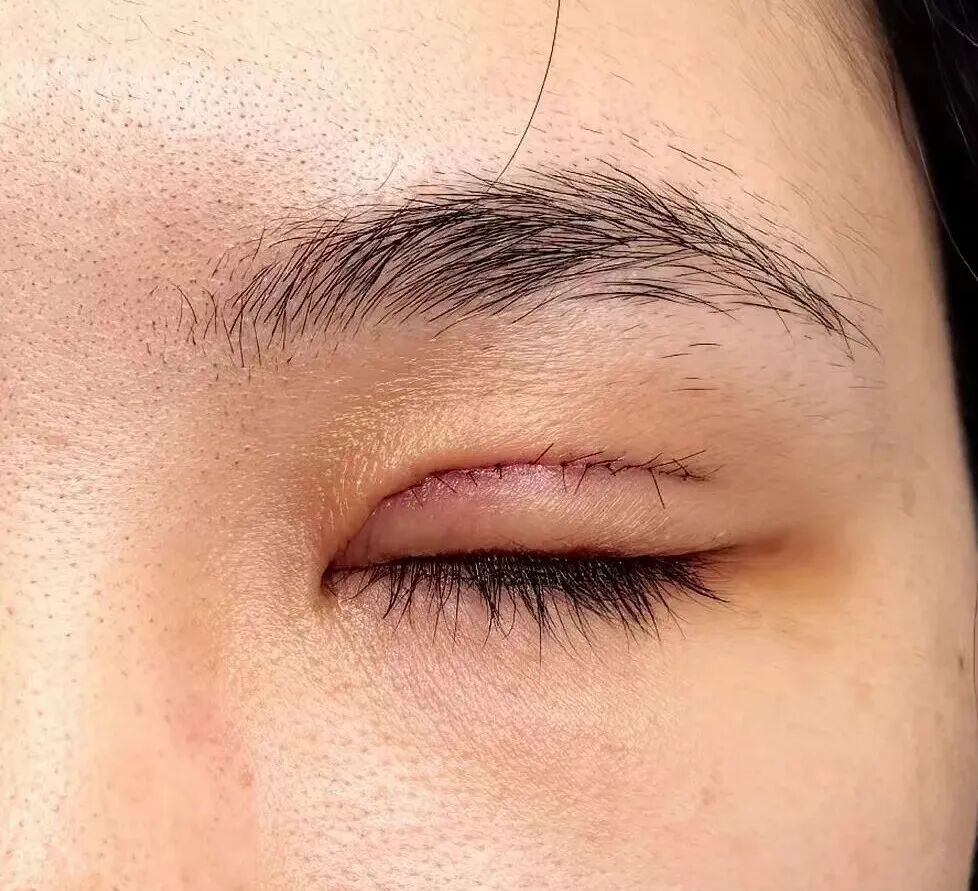 双眼皮增生了怎么办多久能恢复好？