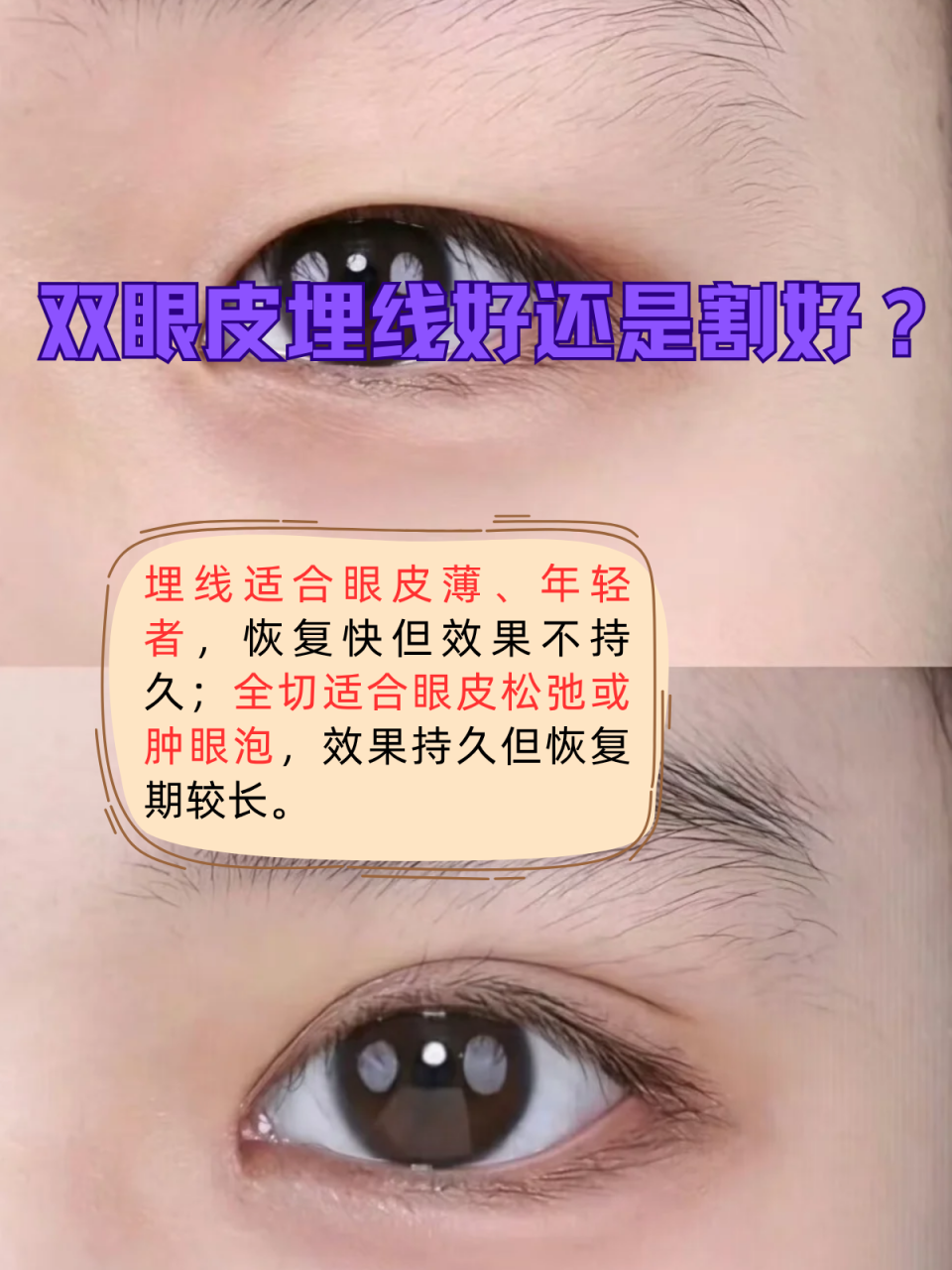 埋线和全切双眼皮哪个好？埋线与全切双眼皮手术效果及恢复期对比