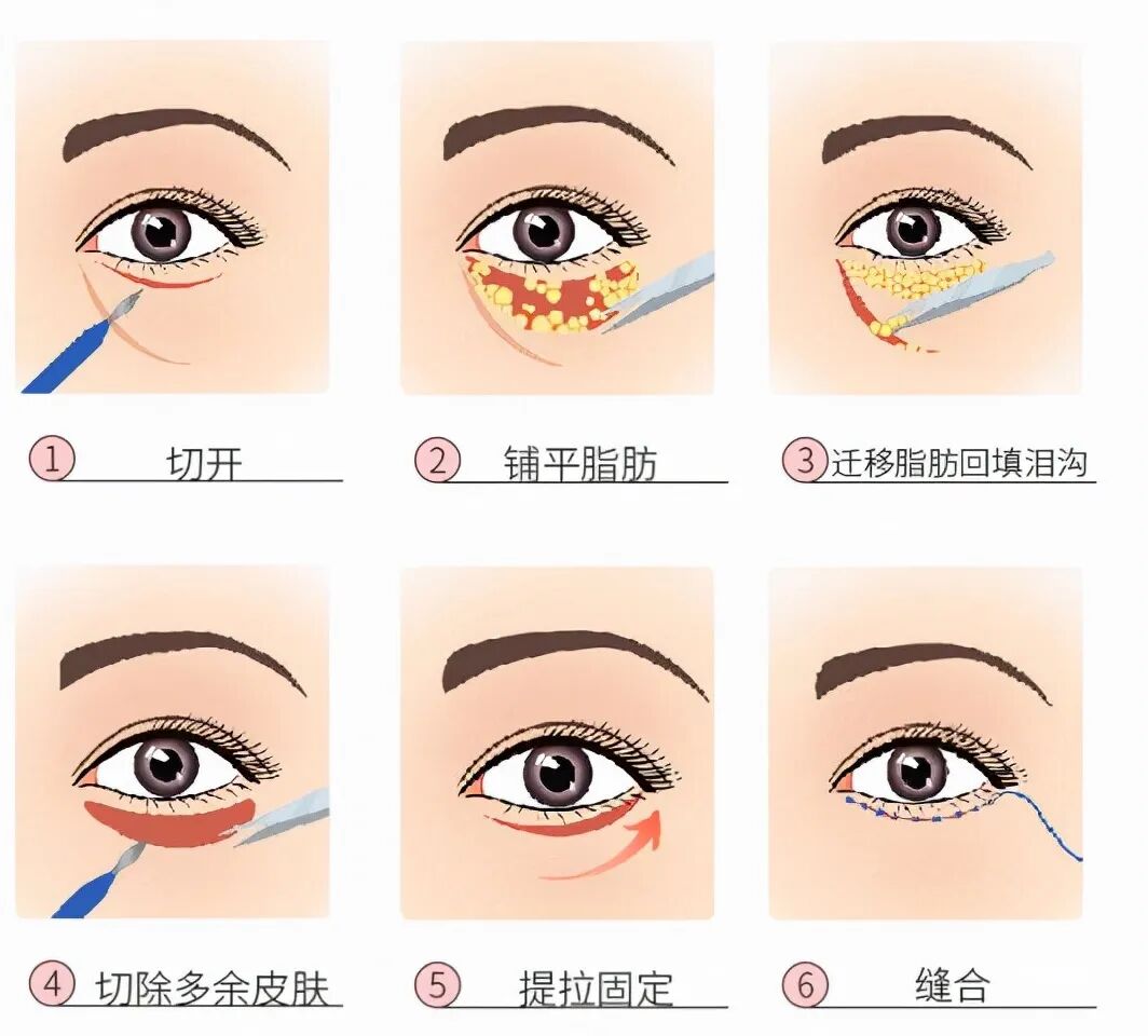 广州去眼袋手术预约指南 | 如何选择合适的去眼袋医院