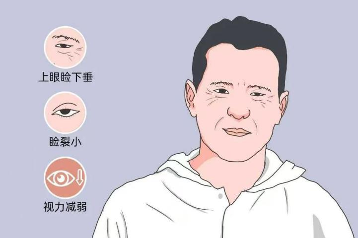 上眼睑下垂有必要正畸矫正吗？