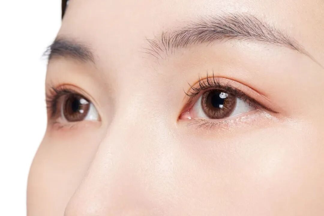 开内眼角和外眼角哪个显眼大？多久能恢复？