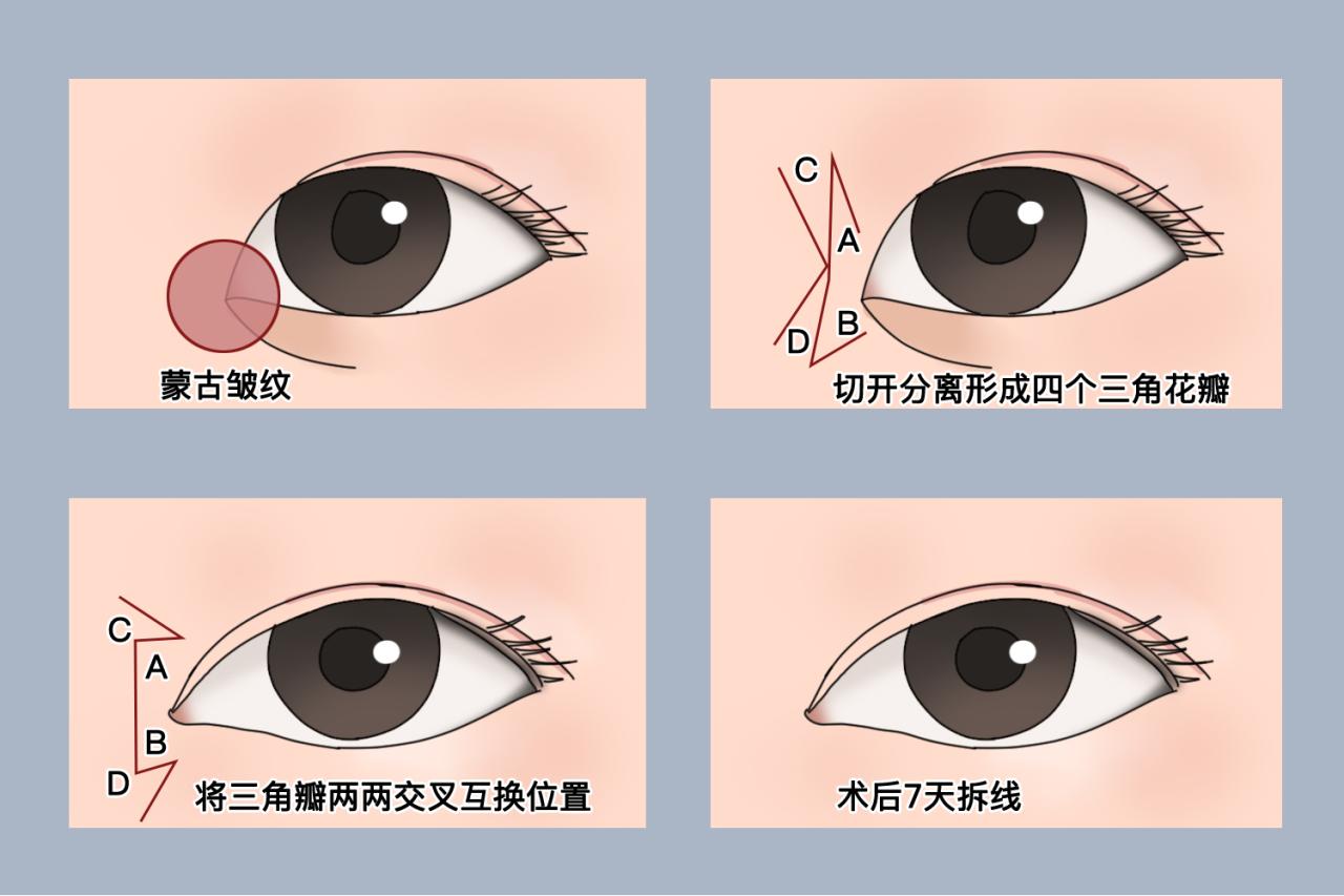 开眼角手术费用多少钱？不同地区开眼角大概费用