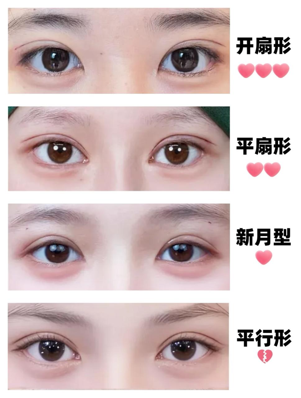 眼综合与单纯双眼皮的区别有哪些？眼综合手术与传统双眼皮手术之间的差异