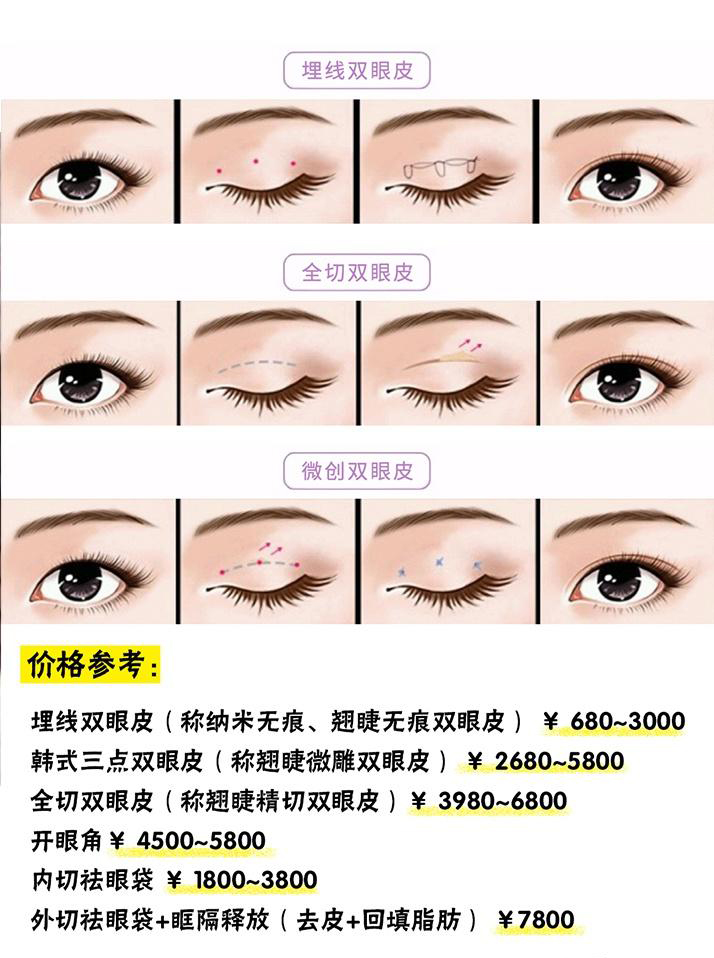全切双眼皮价格多少钱？手术费用及注意事项