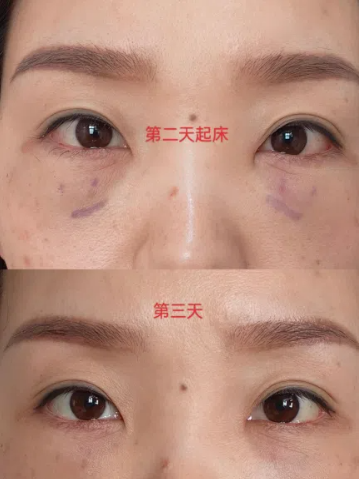 广州去眼袋哪家医院好？广州专业去眼袋医院推荐