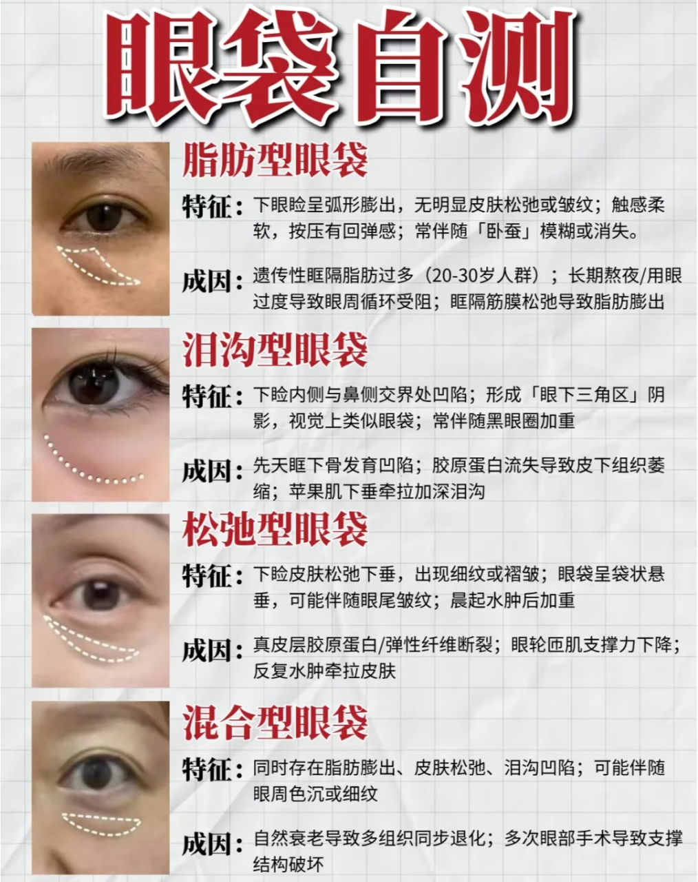不开刀去眼袋真的靠谱吗？非手术方法去除眼袋效果怎么样