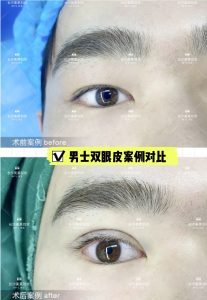 刘欢医生男士双眼皮案例缩略图