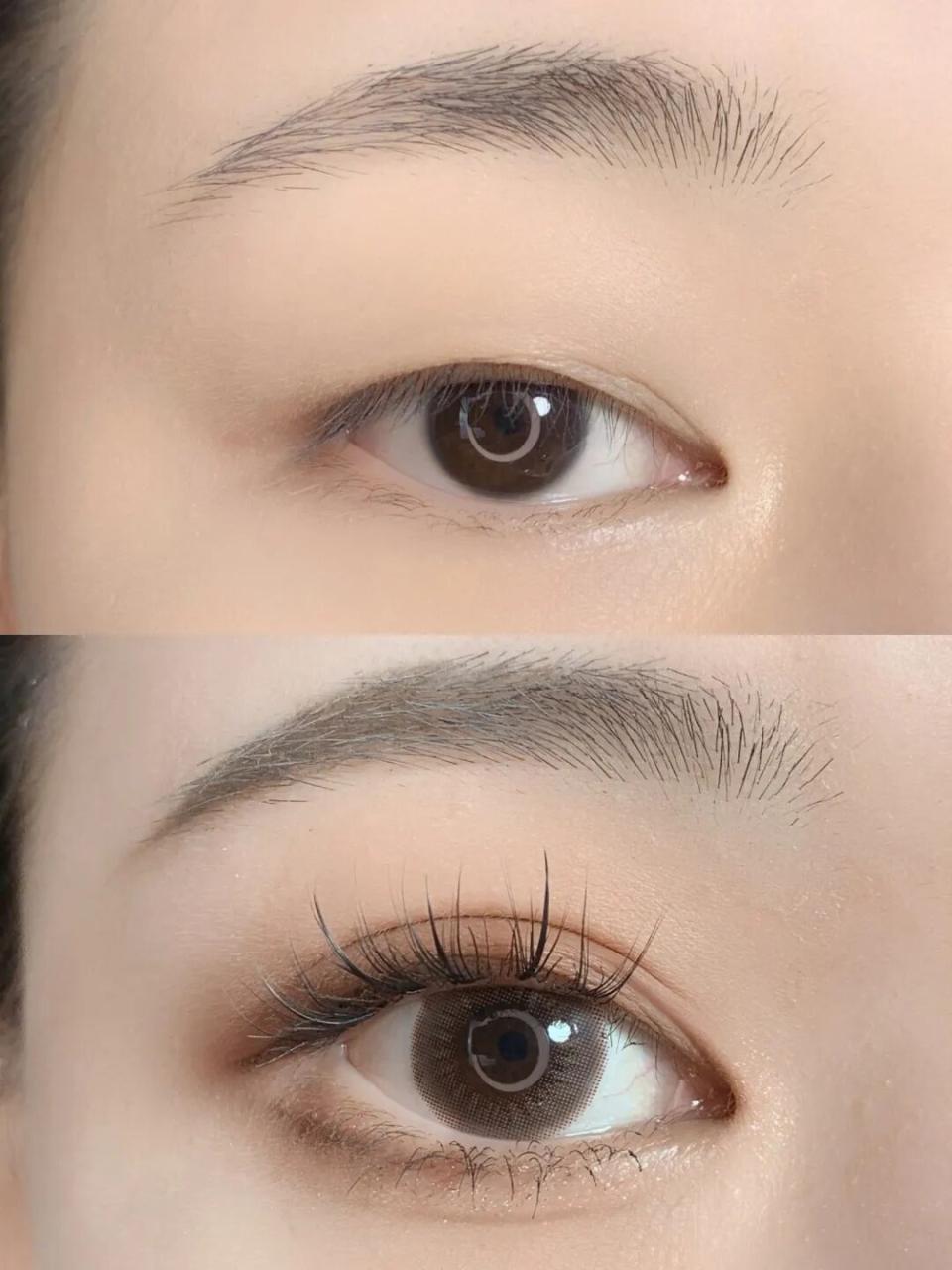 做完双眼皮多久自然?明显吗?