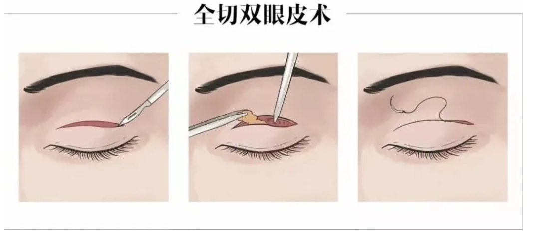 双眼皮全切好还是埋线好？双眼皮全切和埋线哪个美观？