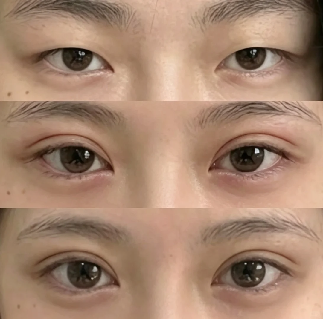保定整形做双眼皮手术多少钱？保定整形做双眼皮手术有哪些好处？