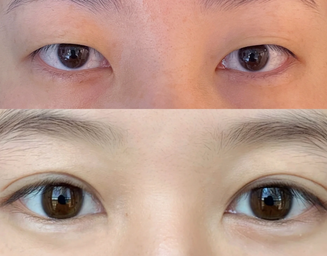 双眼皮手术一般多钱？双眼皮手术安全不安全？