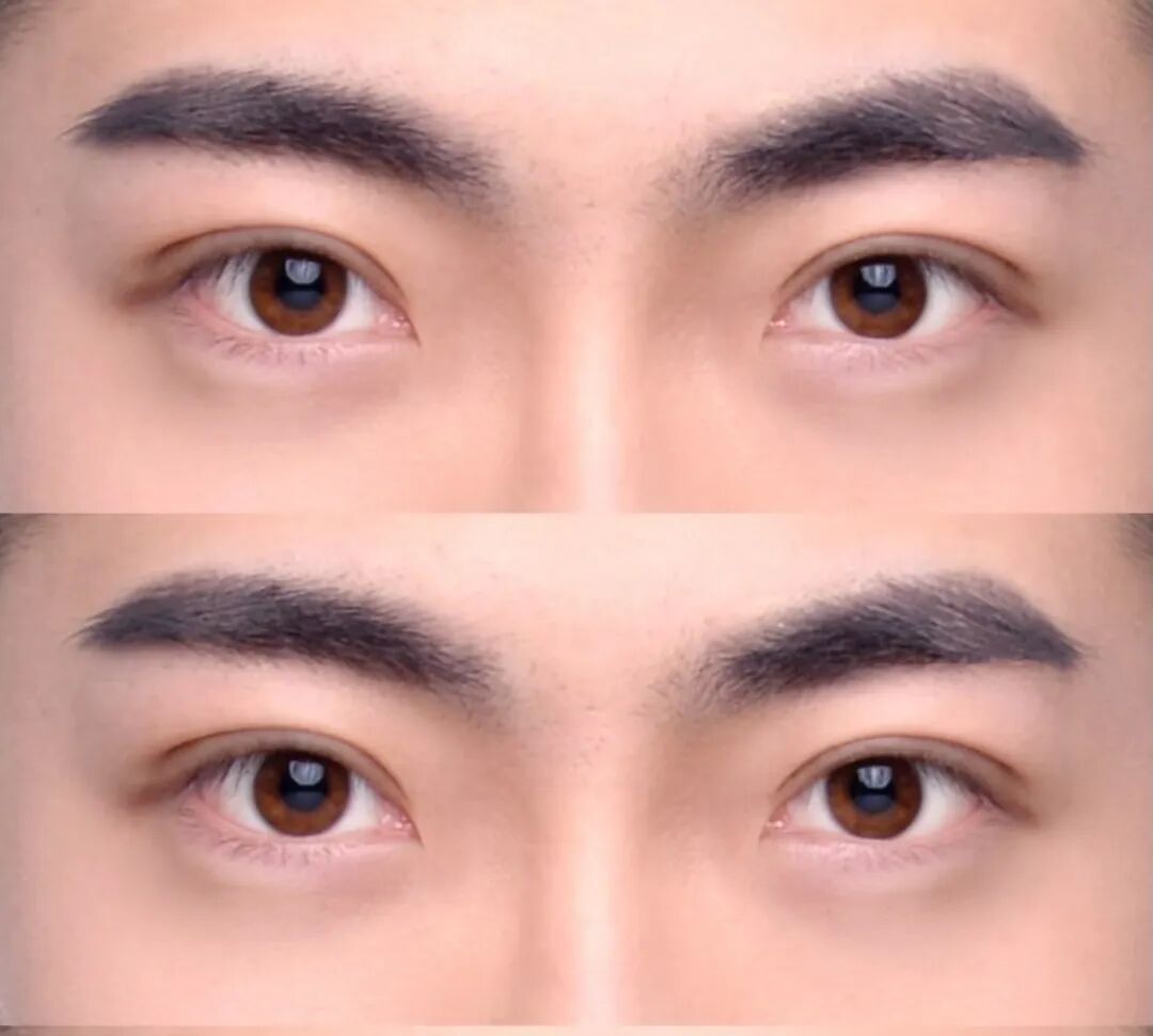 双眼皮整形手术有哪些？做双眼皮整形手术有哪些好处？