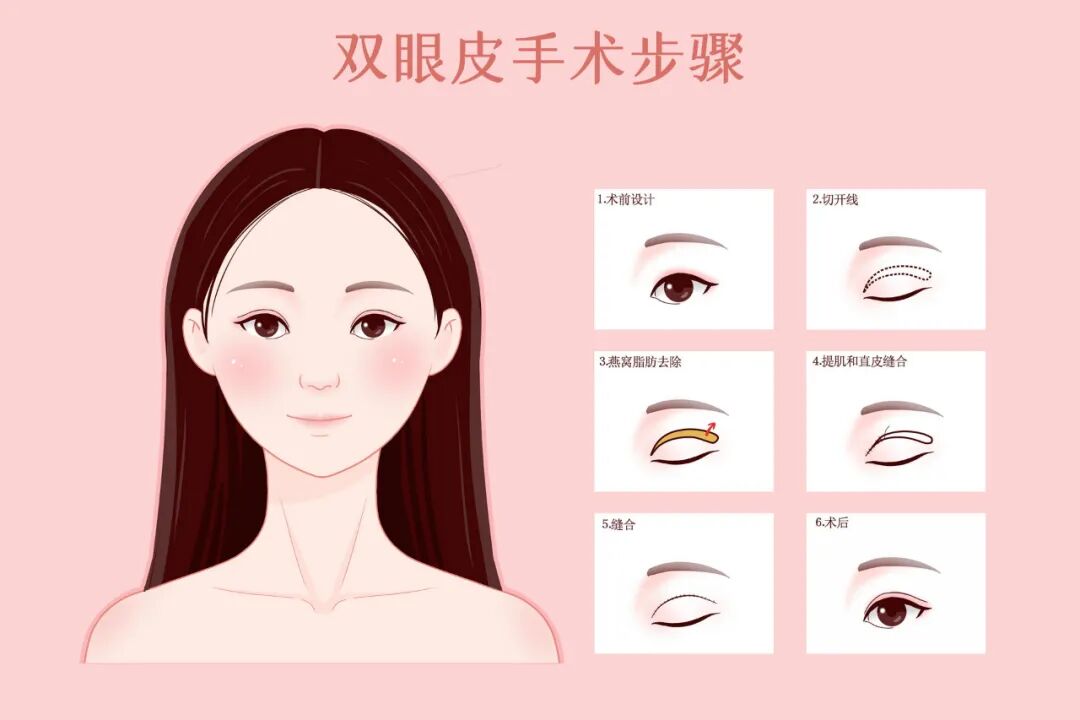 武汉做双眼皮术多少钱?双眼皮手术可能留疤吗?