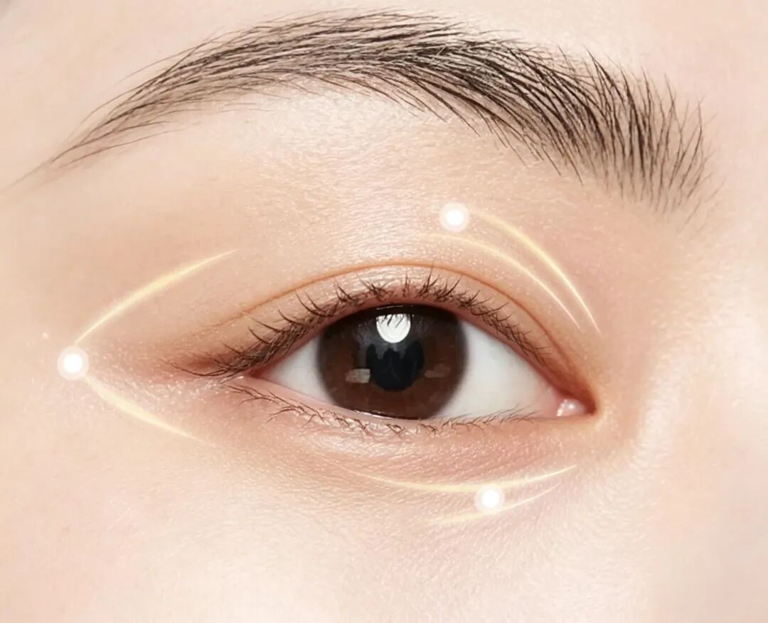 武汉哪里割双眼皮手术?双眼皮手术多久恢复自然?