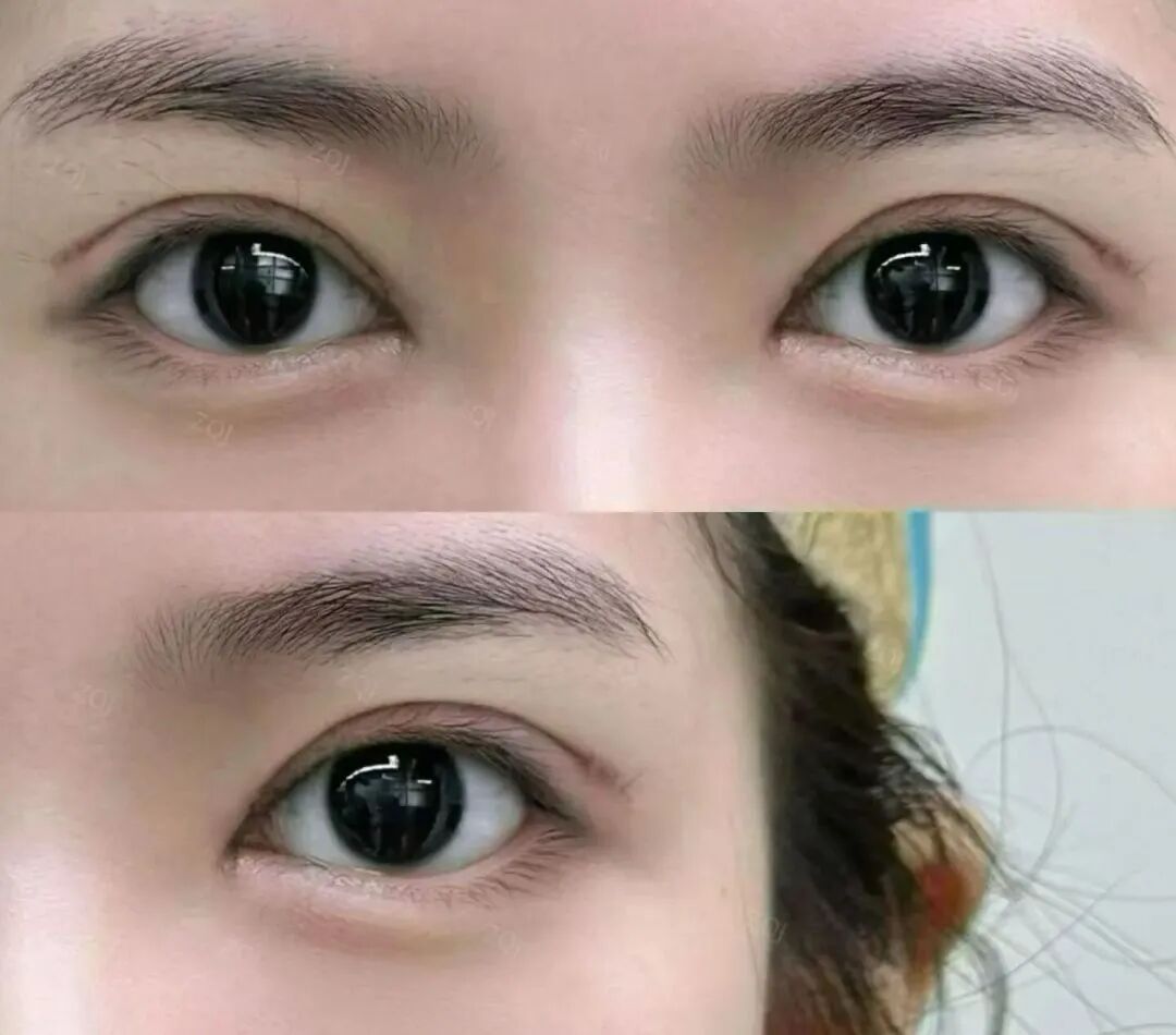 割双眼皮的危害和价格?割双眼皮需要注意的事项有哪些?