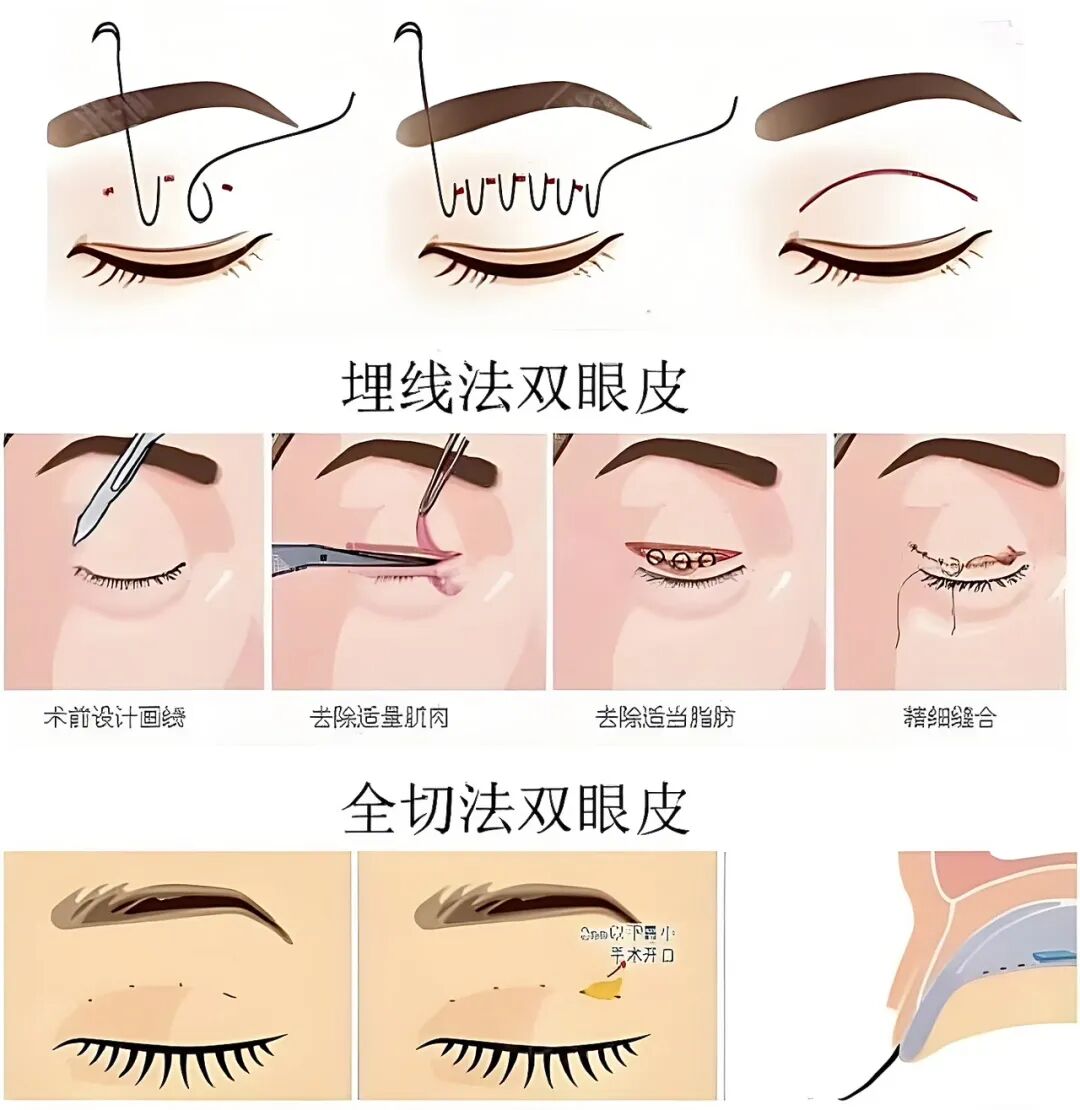 做双眼皮手术的价钱？双眼皮手术有哪些？