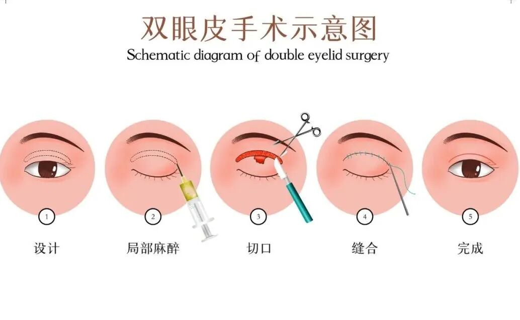 双眼皮手术的价格是多少？双眼皮手术选哪种？