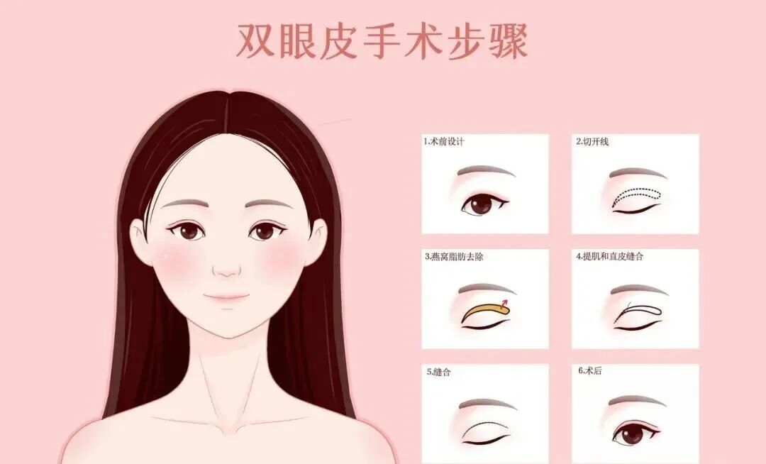 双眼皮手术多少钱一次？双眼皮手术有哪些？
