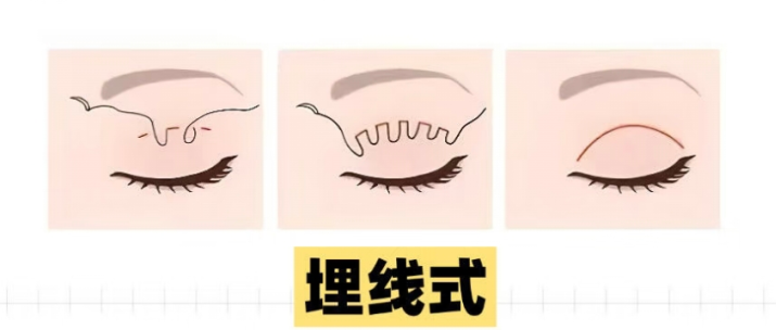 双眼皮做哪种效果好?双眼皮手术后会有瘢痕吗?