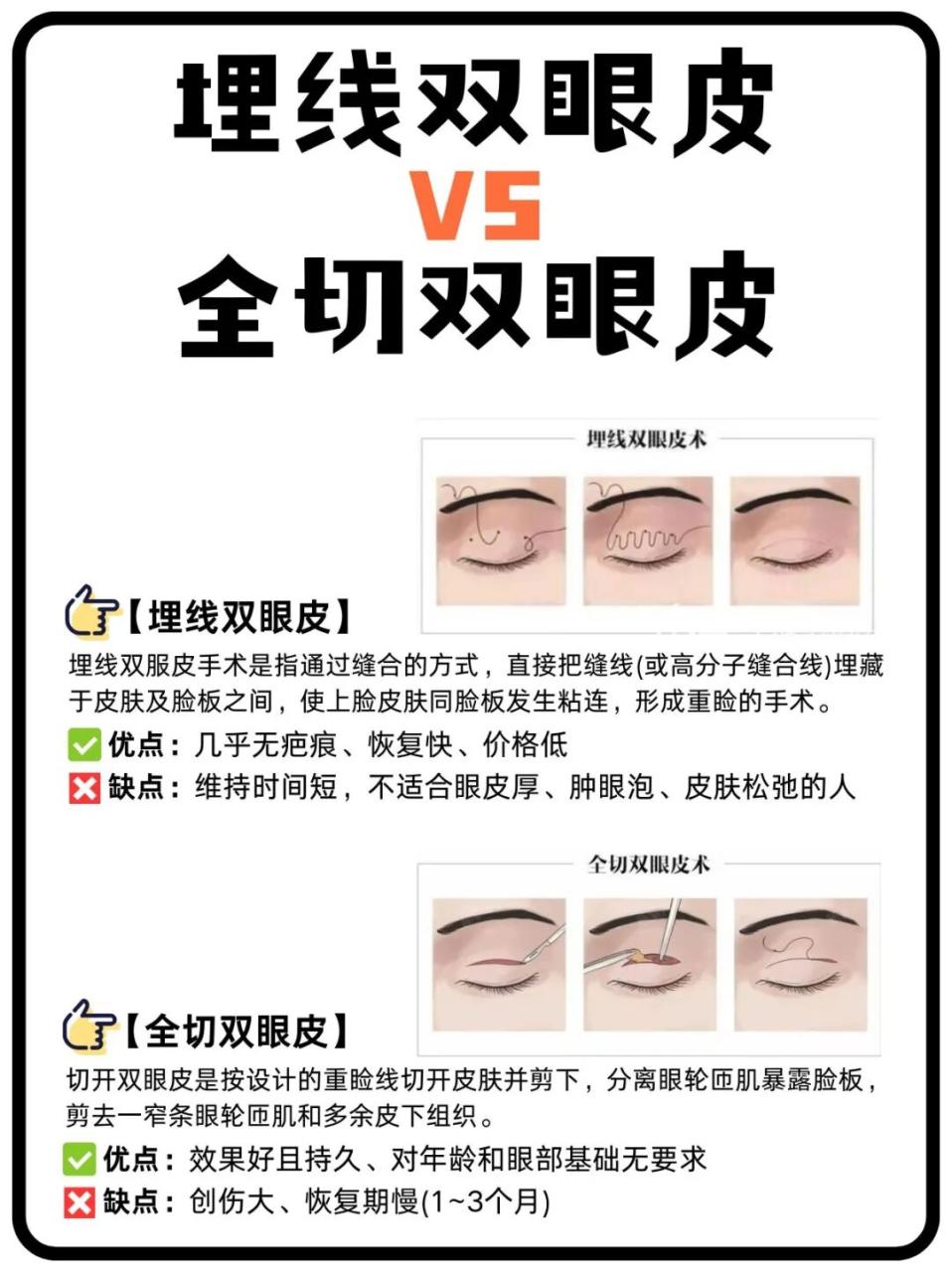 割双眼皮好还是埋线好？割双眼皮多长时间恢复？
