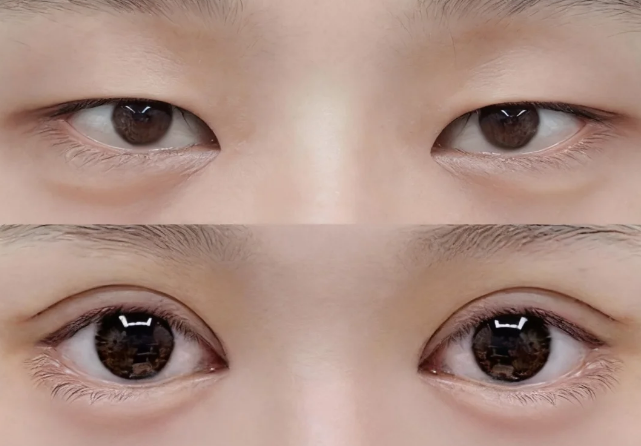 做了一次双眼皮还可以做第二次吗？双眼皮能做几次？