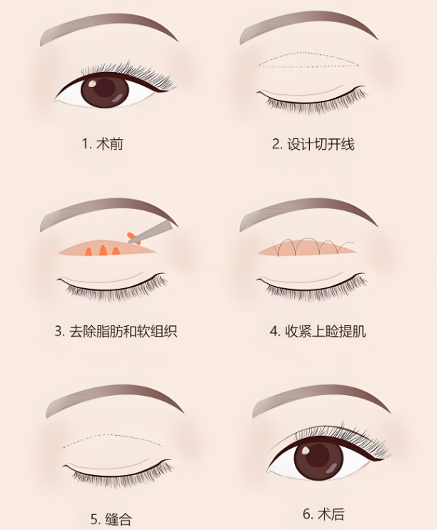 上海整形双眼皮价格表，上海整形双眼皮手术后多久恢复？