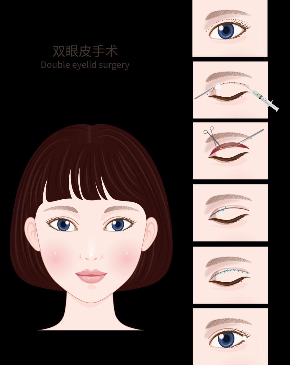 割双眼皮恢复期要多久?影响双眼皮术后多久恢复的因素?