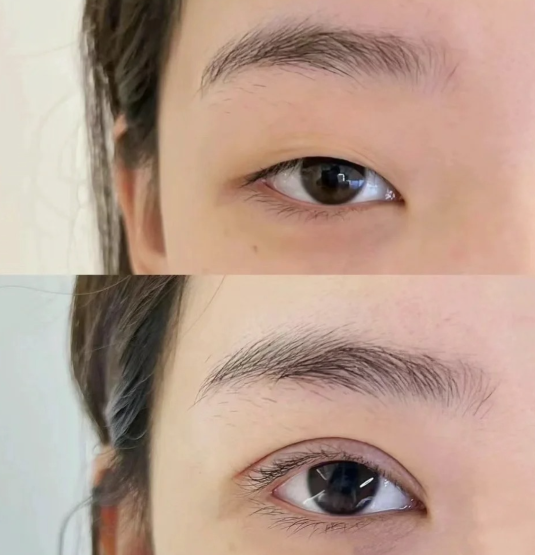 双眼皮手术哪个好？双眼皮有哪些款式？