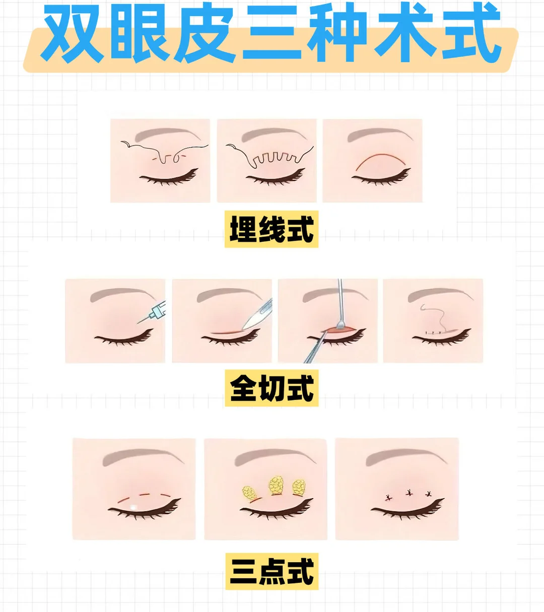 双眼皮手术多久能恢复自然？双眼皮手术有没有风险？