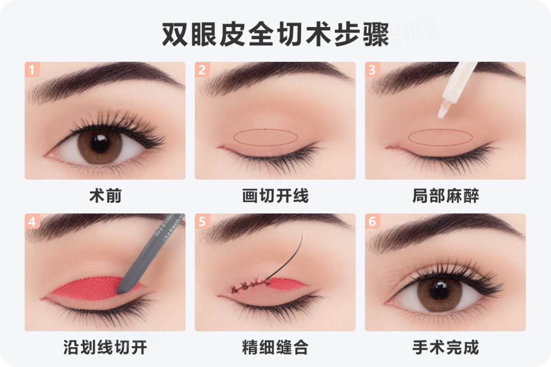 双眼皮手术费多少钱？是不是每个人都适合做双眼皮手术？
